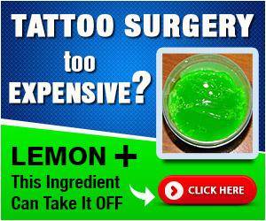 Tattoo Removal