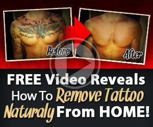 Tattoos Removal